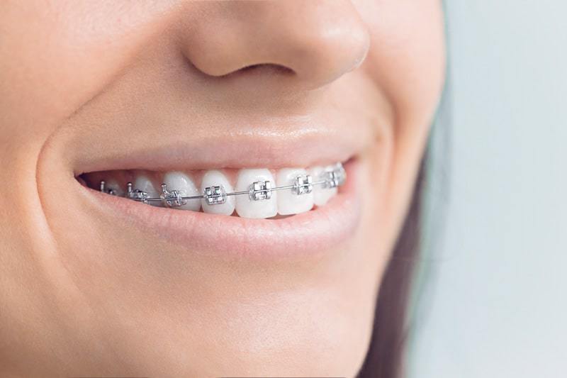 The Orthodontic Clinic, P.C. - Conventional Braces